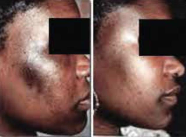 6 Weeks Treatment