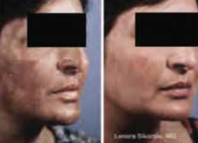 4 Weeks Treatment