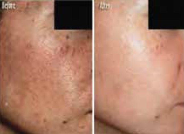 4 Weeks Treatment