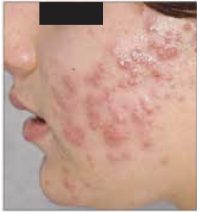 Before Treatment