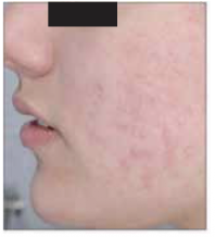 After Treatment