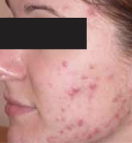 Before Treatment