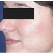 After Treatment