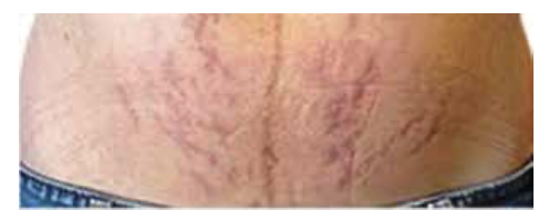 Before Stretch Marks Treatment