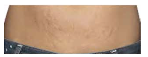 After 8 Weeks of Treatment